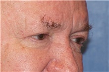 Eyelid Surgery After Photo by George John Alexander, MD, FACS; ,  - Case 32142