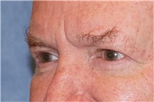 Eyelid Surgery After Photo by George John Alexander, MD, FACS; ,  - Case 32142