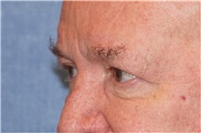 Eyelid Surgery Before Photo by George John Alexander, MD, FACS; ,  - Case 32142