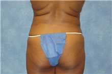 Liposuction After Photo by George John Alexander, MD, FACS; ,  - Case 32298