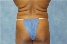 Liposuction Before Photo by George John Alexander, MD, FACS; ,  - Case 32298