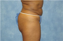 Liposuction After Photo by George John Alexander, MD, FACS; ,  - Case 32298