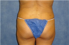 Liposuction After Photo by George John Alexander, MD, FACS; ,  - Case 32299