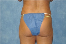 Liposuction After Photo by George John Alexander, MD, FACS; ,  - Case 32301