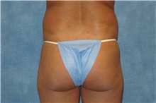 Liposuction Before Photo by George John Alexander, MD, FACS; ,  - Case 32301