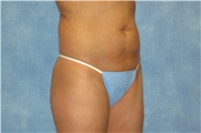 Liposuction Before Photo by George John Alexander, MD, FACS; ,  - Case 32301