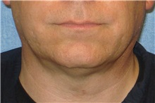 Liposuction After Photo by George John Alexander, MD, FACS; ,  - Case 32303