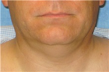 Liposuction Before Photo by George John Alexander, MD, FACS; ,  - Case 32303