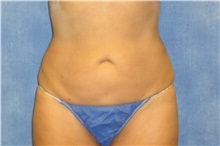 Liposuction After Photo by George John Alexander, MD, FACS; Las Vegas, NV - Case 32304