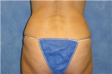 Liposuction After Photo by George John Alexander, MD, FACS; ,  - Case 32304