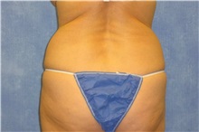Liposuction Before Photo by George John Alexander, MD, FACS; ,  - Case 32304