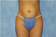Liposuction After Photo by George John Alexander, MD, FACS; ,  - Case 32305