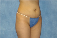 Liposuction Before Photo by George John Alexander, MD, FACS; ,  - Case 32305