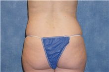 Liposuction After Photo by George John Alexander, MD, FACS; ,  - Case 32308