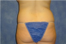 Liposuction Before Photo by George John Alexander, MD, FACS; ,  - Case 32308