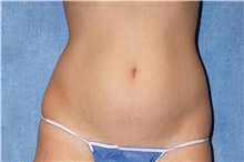 Liposuction Before Photo by George John Alexander, MD, FACS; ,  - Case 32309
