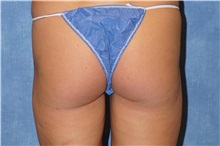 Liposuction After Photo by George John Alexander, MD, FACS; ,  - Case 32309