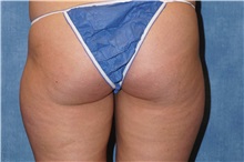 Liposuction Before Photo by George John Alexander, MD, FACS; ,  - Case 32309