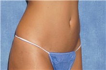 Liposuction After Photo by George John Alexander, MD, FACS; ,  - Case 32309