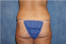 Liposuction After Photo by George John Alexander, MD, FACS; ,  - Case 32310
