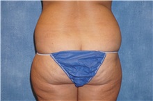 Liposuction Before Photo by George John Alexander, MD, FACS; ,  - Case 32310