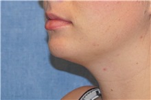 Liposuction After Photo by George John Alexander, MD, FACS; ,  - Case 32311