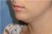 Liposuction Before Photo by George John Alexander, MD, FACS; ,  - Case 32311