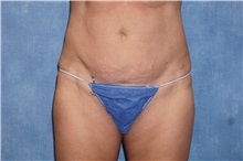 Liposuction After Photo by George John Alexander, MD, FACS; ,  - Case 32312