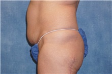 Liposuction Before Photo by George John Alexander, MD, FACS; ,  - Case 32312