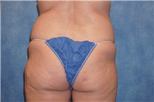 Liposuction Before Photo by George John Alexander, MD, FACS; ,  - Case 32312