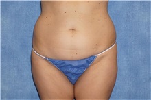 Liposuction Before Photo by George John Alexander, MD, FACS; ,  - Case 32313