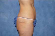 Liposuction After Photo by George John Alexander, MD, FACS; ,  - Case 32313