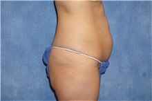 Liposuction Before Photo by George John Alexander, MD, FACS; ,  - Case 32313
