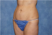 Liposuction After Photo by George John Alexander, MD, FACS; ,  - Case 32313