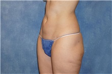 Liposuction After Photo by George John Alexander, MD, FACS; ,  - Case 32315