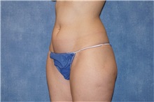 Liposuction Before Photo by George John Alexander, MD, FACS; ,  - Case 32315