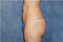 Liposuction After Photo by George John Alexander, MD, FACS; ,  - Case 32315
