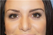 Rhinoplasty After Photo by George John Alexander, MD, FACS; Las Vegas, NV - Case 32328