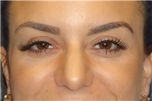 Rhinoplasty Before Photo by George John Alexander, MD, FACS; Las Vegas, NV - Case 32328