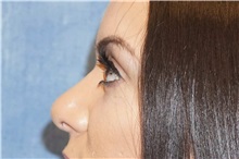 Rhinoplasty After Photo by George John Alexander, MD, FACS; Las Vegas, NV - Case 32328