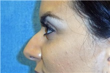 Rhinoplasty Before Photo by George John Alexander, MD, FACS; Las Vegas, NV - Case 32328