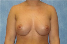 Breast Augmentation After Photo by George John Alexander, MD, FACS; ,  - Case 32332