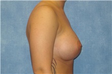 Breast Augmentation After Photo by George John Alexander, MD, FACS; ,  - Case 32332