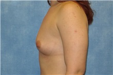 Breast Augmentation Before Photo by George John Alexander, MD, FACS; ,  - Case 32332