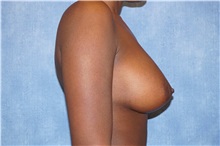 Breast Augmentation After Photo by George John Alexander, MD, FACS; ,  - Case 32336