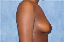 Breast Augmentation Before Photo by George John Alexander, MD, FACS; ,  - Case 32336