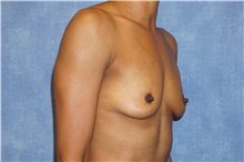 Breast Augmentation Before Photo by George John Alexander, MD, FACS; ,  - Case 32337