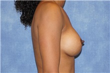 Breast Augmentation After Photo by George John Alexander, MD, FACS; ,  - Case 32337