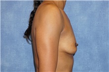 Breast Augmentation Before Photo by George John Alexander, MD, FACS; ,  - Case 32337