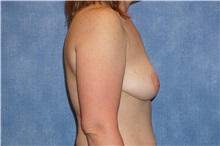 Breast Augmentation Before Photo by George John Alexander, MD, FACS; ,  - Case 32339